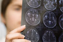 Brain Aneurysm With Interventional Radiology